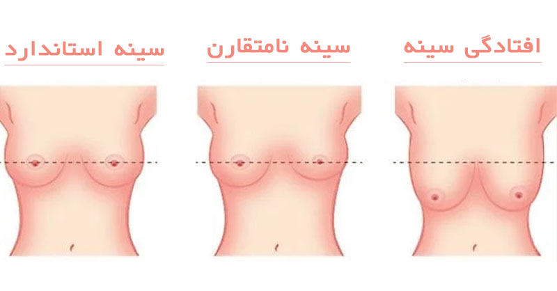 لیفت سینه بدون بی هوشی