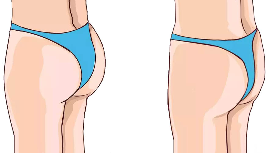 مزایا و معایب پروتز باسن